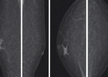 619 мужчин прошли маммографию: генеральный директор «Олимп» объяснил, зачем это нужно