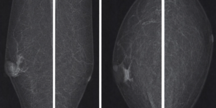 619 мужчин прошли маммографию: генеральный директор «Олимп» объяснил, зачем это нужно